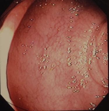 Sprue. Photograph from duodenal endoscopy in a pat