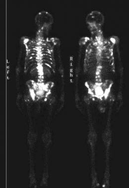 Isotopic bone scans show multiple areas of increas