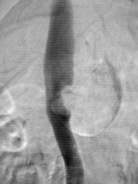 Inferior cavography demonstrates thrombus extendin