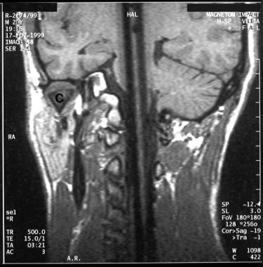 Coronal T1-weighted MRI sequence through the left 