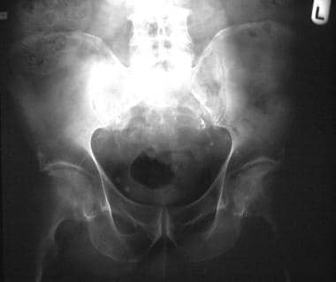 Plain radiograph in a 68-year-old man with hip pai