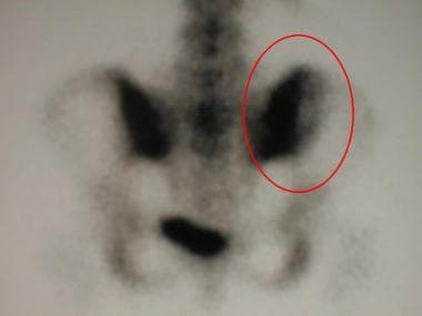 Delayed bone scan image of the pelvis (posterior v