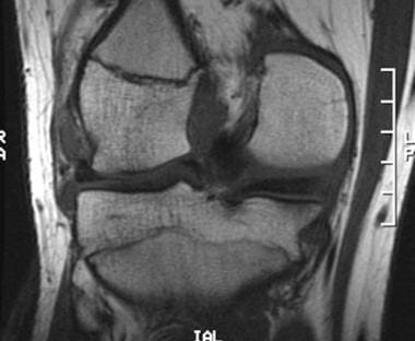 Coronal T1-weighted image 2 weeks after injury is 