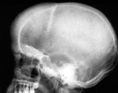 Thalassemia. Lateral skull radiograph. Widening of
