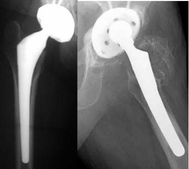 Variable geometry of cementless femoral stems to a