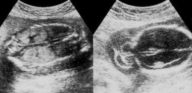 Meckel-Gruber syndrome. Ultrasonograms show oligoh