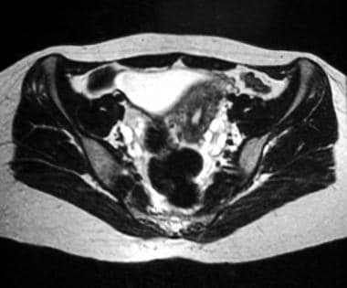 Axial T2-weighted magnetic resonance image of the 