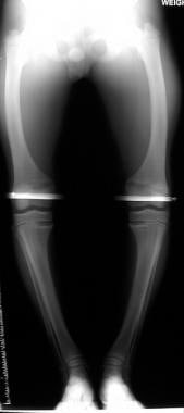 Radiograph of a leg with the patient in a standing