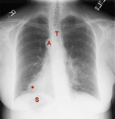 Posteroanterior chest radiograph in a 55-year-old 