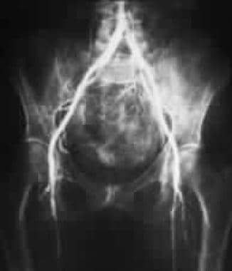 Lumbar angiogram showing stenosis and occlusion of