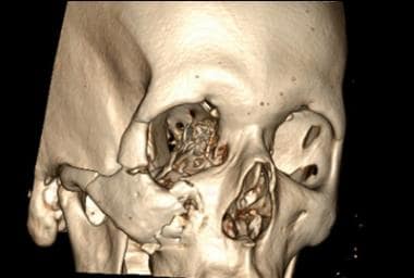 Zygomaticomaxillary complex (ZMC) fracture. Courte