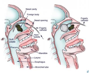 Use of a Fogarty catheter to remove a nasal foreig