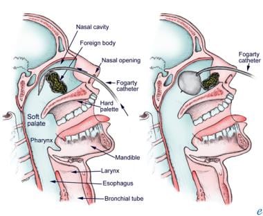 Smell of success: E-nose device sniffs out lung disease - Medical Plastics  News