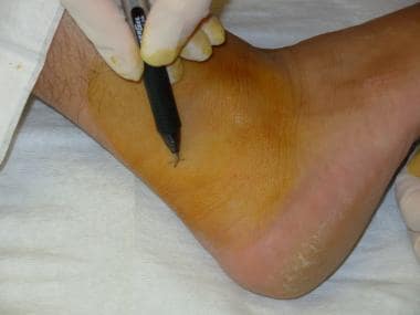 Mark the site adjacent to the Achilles tendon. 