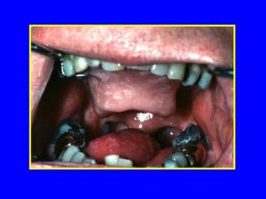 A partial glossectomy with an artificial tongue at