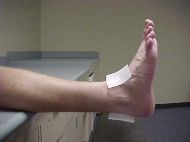 Ankle taping and bracing. Lateral view of correct 