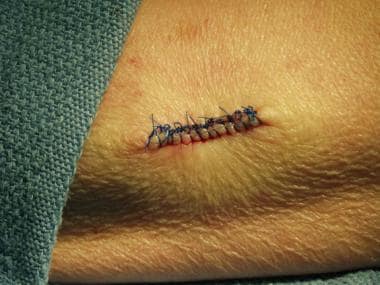 Stitches (Sutures) 101: Overview, Types, Procedures & Removal - Homage