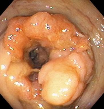 Colon cancer seen on colonoscopy. 