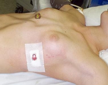 A 12-year-old girl with severe pectus excavatum im.