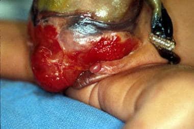 46,XY newborn with cloacal exstrophy. Very large o