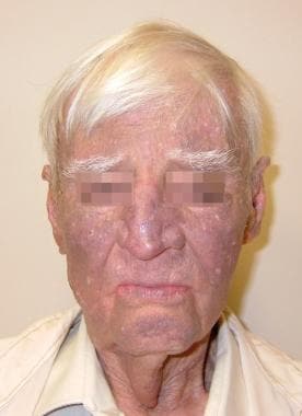 What is argyria, a condition that turns skin colour to blue?