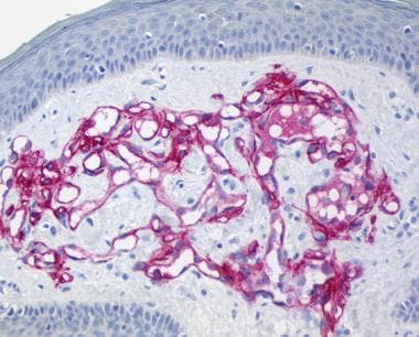 High-power view showing lymphatic endothelial cell