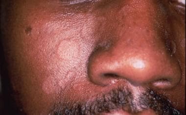 infantile seborrheic dermatitis face