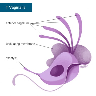 trichomoniasis men