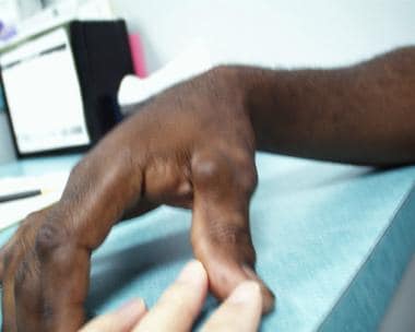 Venous malformations on a patient's right hand. 