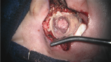 Intraoperative image of a right ear with the skin 
