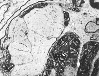 Microscopic demonstration of demyelination in prim