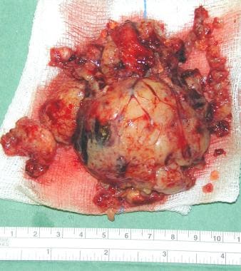 Case 2: Surgical specimen. Complete resection was 