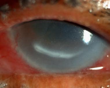 fungal corneal ulcer satellite lesion