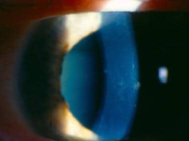 Slit lamp image demonstrates posterior corneal ves