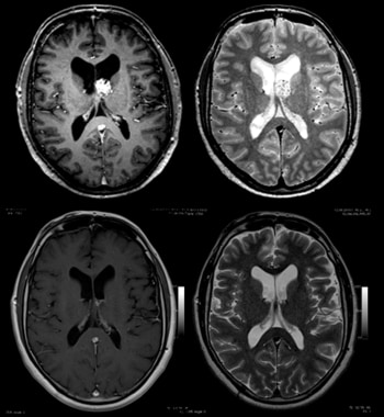 MRI images of an ependymoma in the left ventricle.