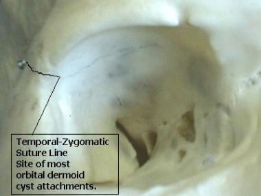 Temporal-zygomatic suture line on the lateral orbi