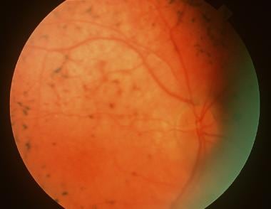 Retinitis Pigmentosa Treatment Management Medical Care - 