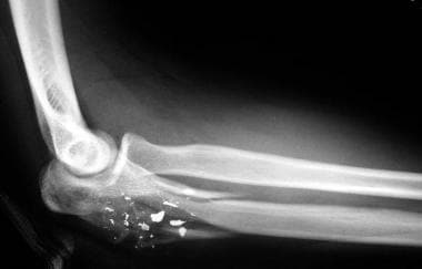 20-year-old man with comminuted olecranon fracture