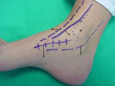 Triple arthrodesis. Anatomy of medial incision: (A
