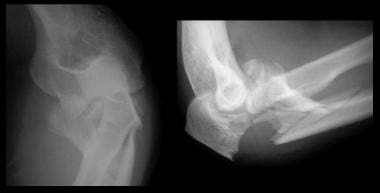 Monteggia variant with radial head fracture. 