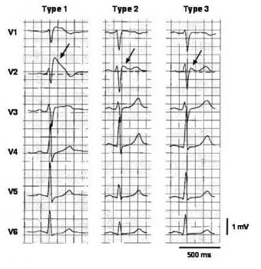 Brugada syn的三种st段抬高