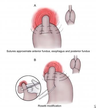 Nissen fundoplication。