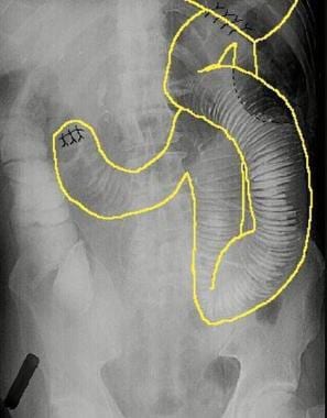 roux en y gastric bypass afferent limb