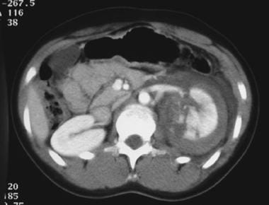 Computed tomography (CT) image of grade IV renal l