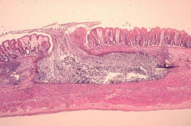 Histopathology of typical flask-shaped ulcer of in