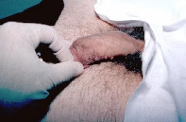 Small papilloma on shaft of penis. 