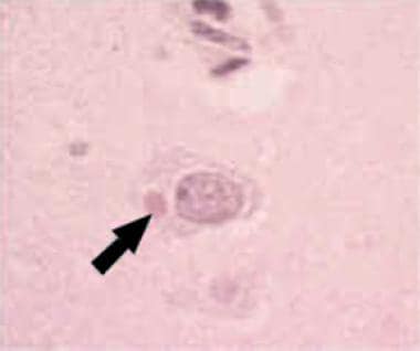 Hematoxylin and eosin stain of Negri body in a rab