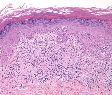 gummas histology