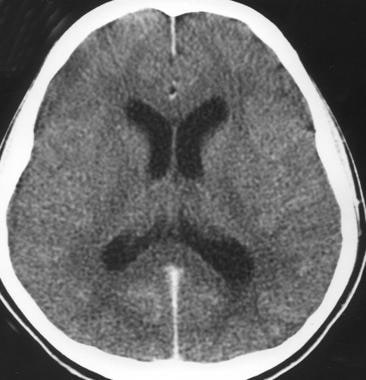 Acute bacterial meningitis. This axial nonenhanced