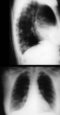 Bacterial pneumonia. Radiographic images in a pati